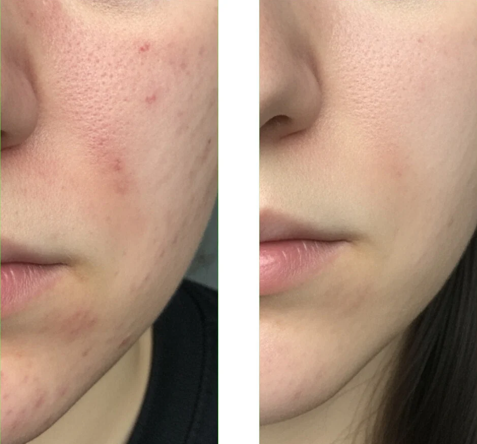 Salicylsyre Ansigtsrens mod bumser og hudorme — Salicylsyre Cleanser opløser talg, forebygger uren hud og giver frisk glød. - Image 6