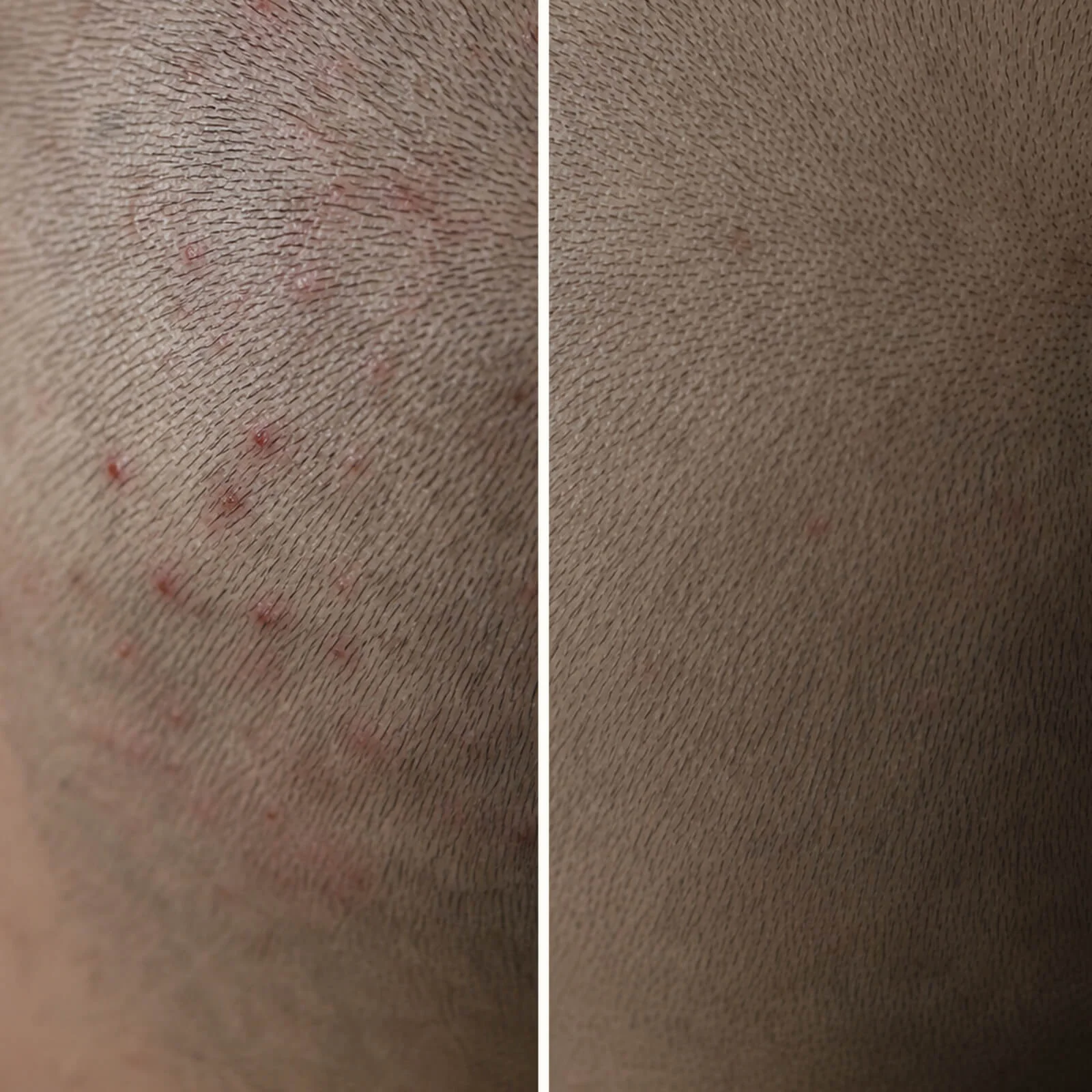 Salicylsyre Gel mod bumser og kløe i hovedbunden — Døjer du med bumser i hovedbunden? Gelen eksfolierer porerne, mindsker olie og beroliger rødme og kløe effektivt. - Image 6
