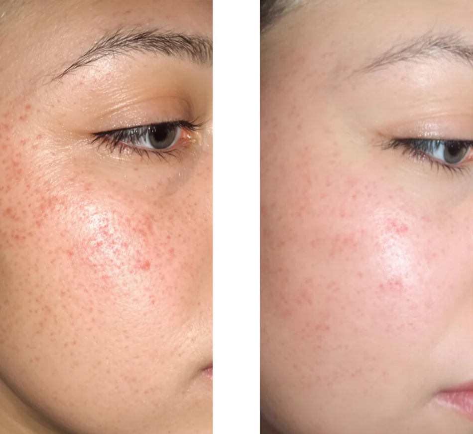 Serum mod bumser, hudorme og uren hud – Salicylsyre 2 % — Serum mod bumser og fedtet hud. Renser porer og dæmper udbrud. Med salicylsyre 2 %, Zinc PCA, grøn te og hyaluronsyre. - Image 6