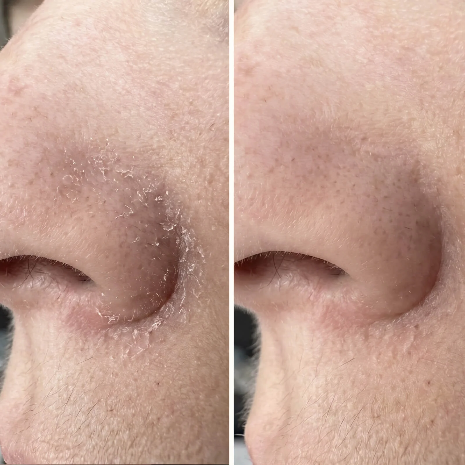 Salicylsyre serum til skæl og flager i ansigt og skæg — Serum til skæl i ansigtet, skæg, øre og øjenbryn. Salicylsyre fjerner flager og rødme hurtigt, så huden igen kommer i sund balance. - Image 6
