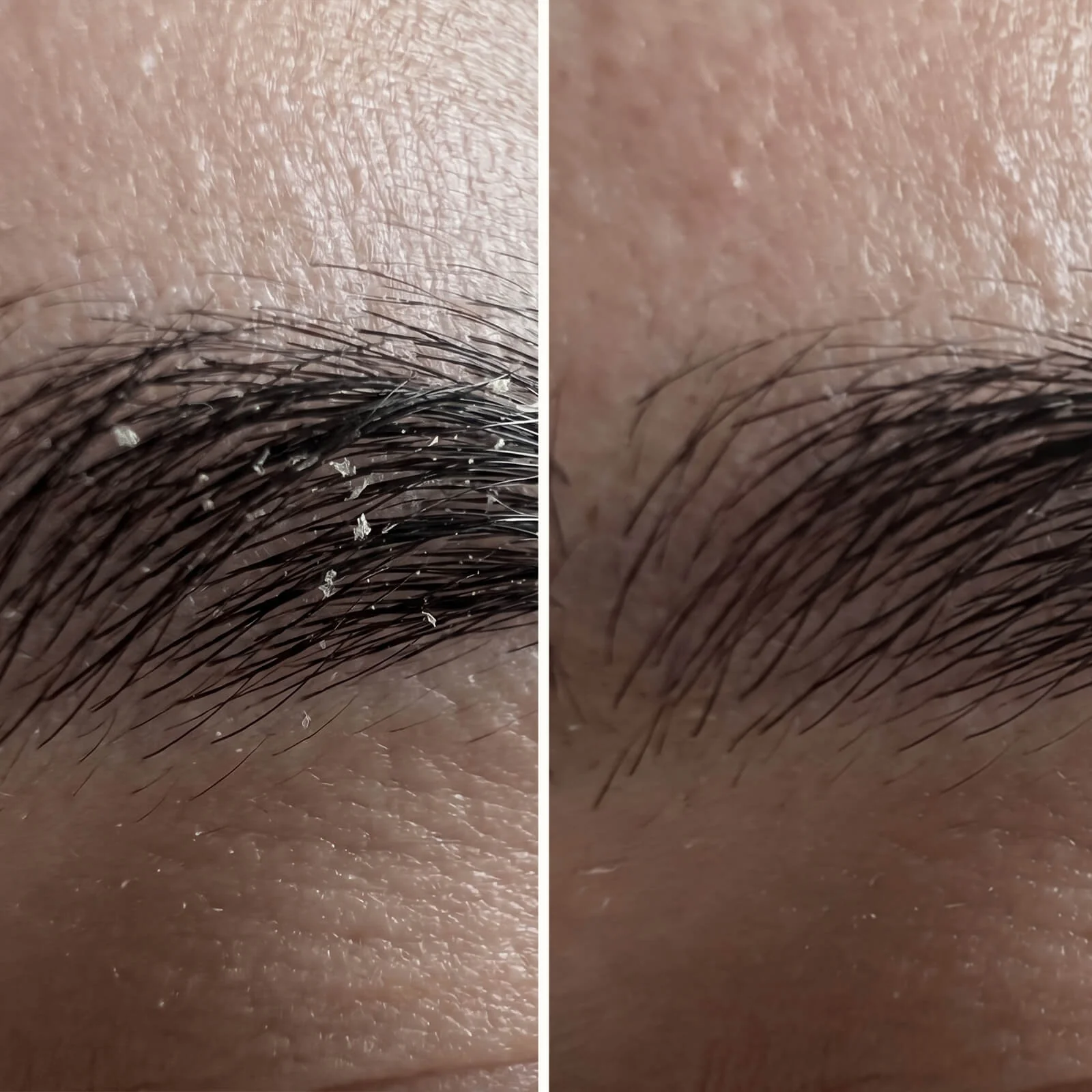 Salicylsyre serum til skæl og flager i ansigt og skæg — Serum til skæl i ansigtet, skæg, øre og øjenbryn. Salicylsyre fjerner flager og rødme hurtigt, så huden igen kommer i sund balance. - Image 7