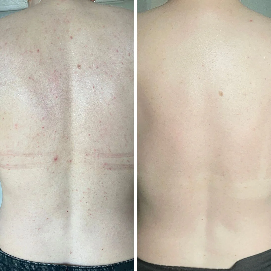 Salicylsyre spray mod bumser og uren hud på kroppen — Salicylsyre spray mod bumser og uren hud. Indeholder salicylsyre og glycolic acid, der renser porer og giver smuk hud. - Image 6