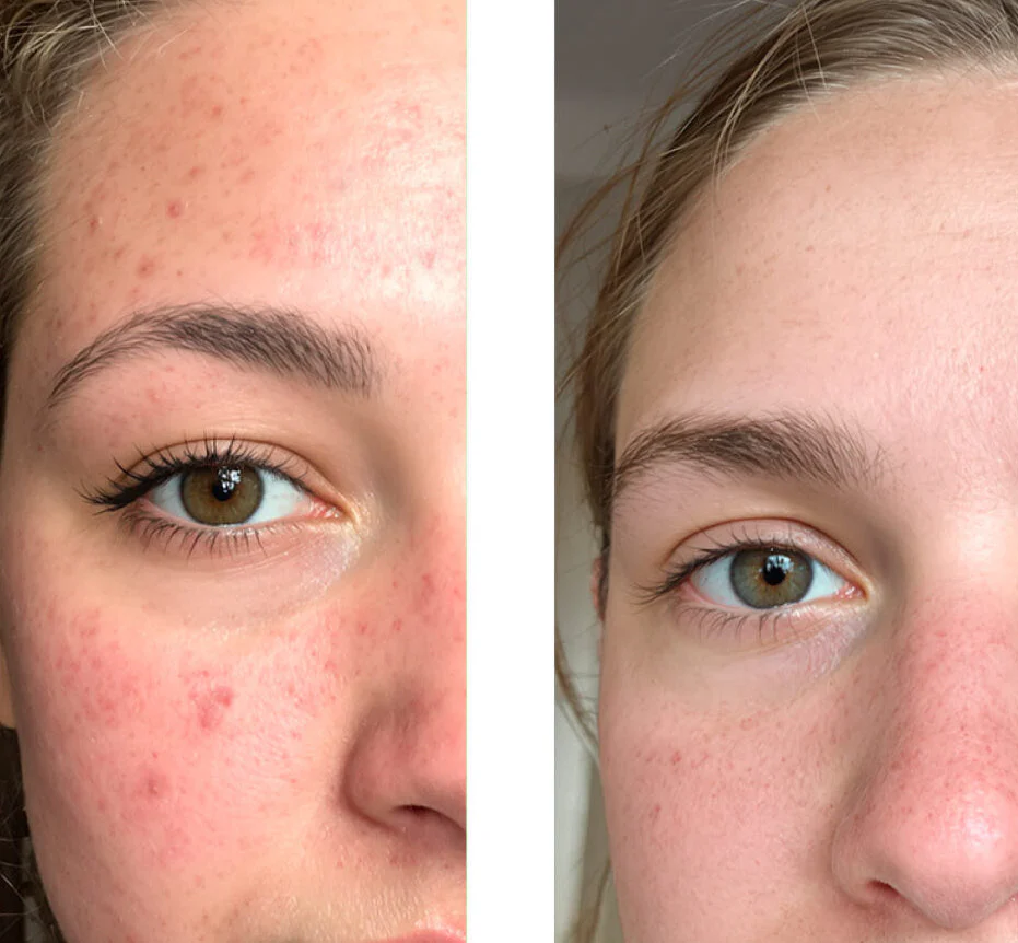 Salicylsyre-toner mod urenheder og store porer — Salicylsyre peeling fjerner hudorme, mindsker porer og udjævner huden. Bruges dagligt for en klar og ren hud. - Image 6